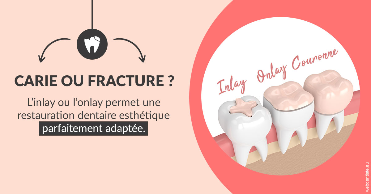 https://docteur-didier-colson.chirurgiens-dentistes.fr/T2 2023 - Carie ou fracture 2