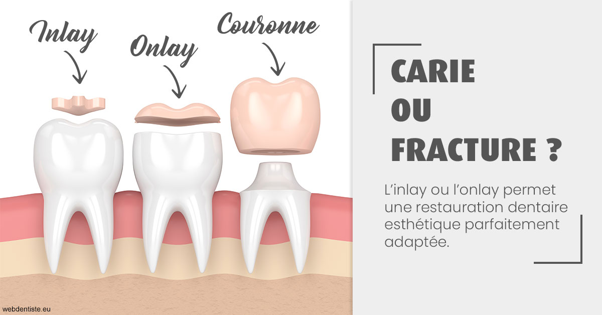 https://docteur-didier-colson.chirurgiens-dentistes.fr/T2 2023 - Carie ou fracture 1