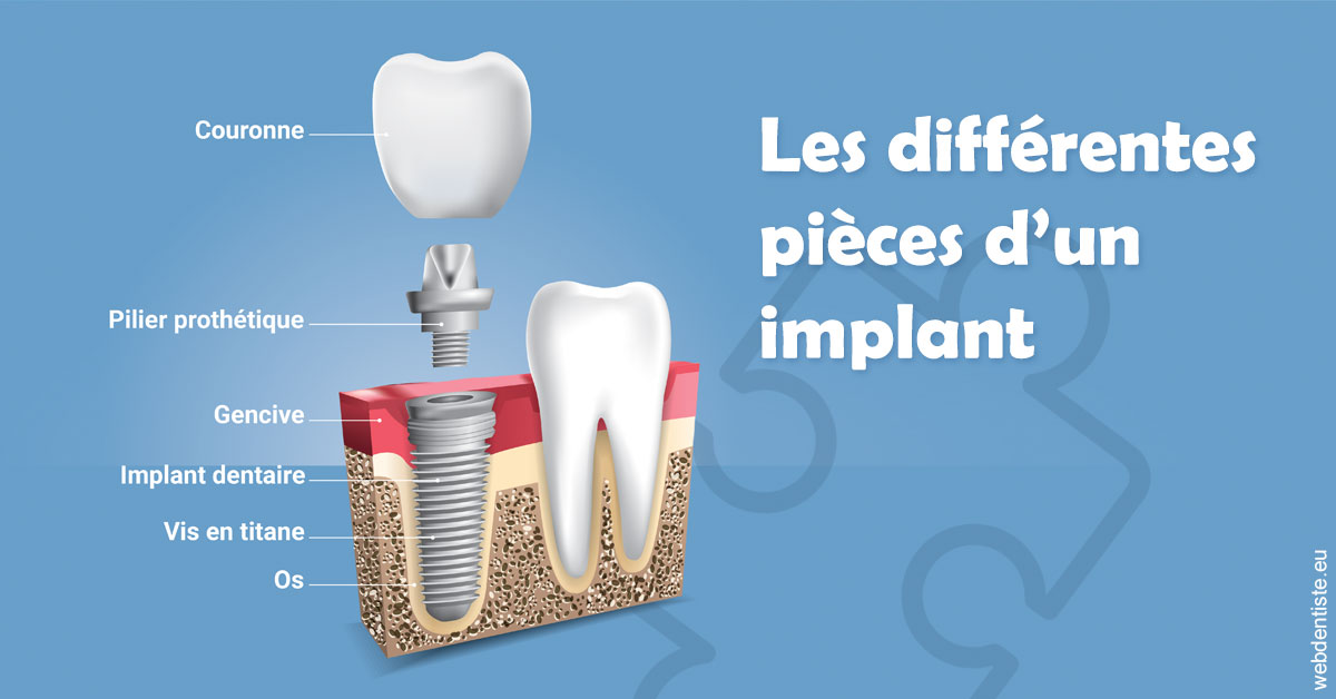 https://docteur-didier-colson.chirurgiens-dentistes.fr/Les différentes pièces d’un implant 1